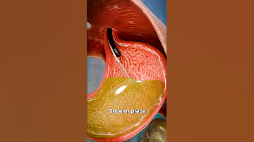 How A Gastric Balloon Works 
