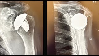 Total Shoulder Surgery Video with Mark Schrumpf, MD
