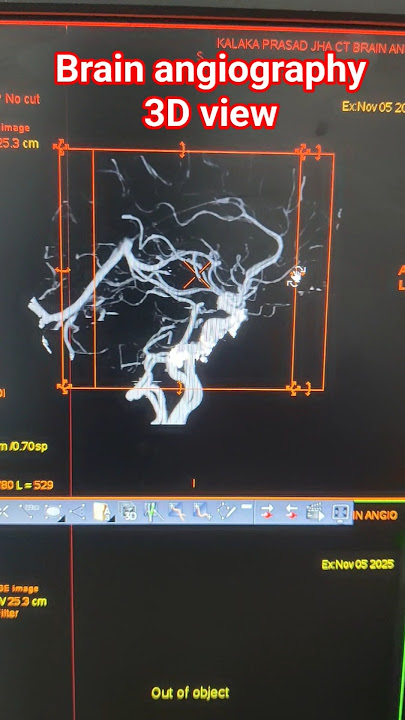 Brain angiography 3D view #angiogram #ctscan #radiology #science