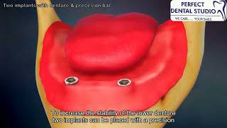 Two implants with denture & precesion bar