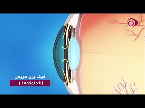 كيف يرى مريض الجلوكوما الماء الأزرق