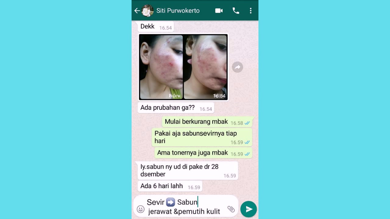 harga obat jerawat loria acne lotion sevir WA 082154239567 - YouTube