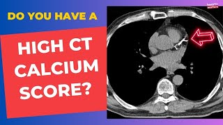 High Calcium Score: What Next? by Heart Matters 72,964 views 8 months ago 14 minutes, 17 seconds