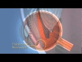 Openangle glaucoma