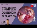 689 - Complex Cholesteatoma Extraction