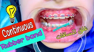 مطاط التقويم المتصل | Orthodontic Finishing stage