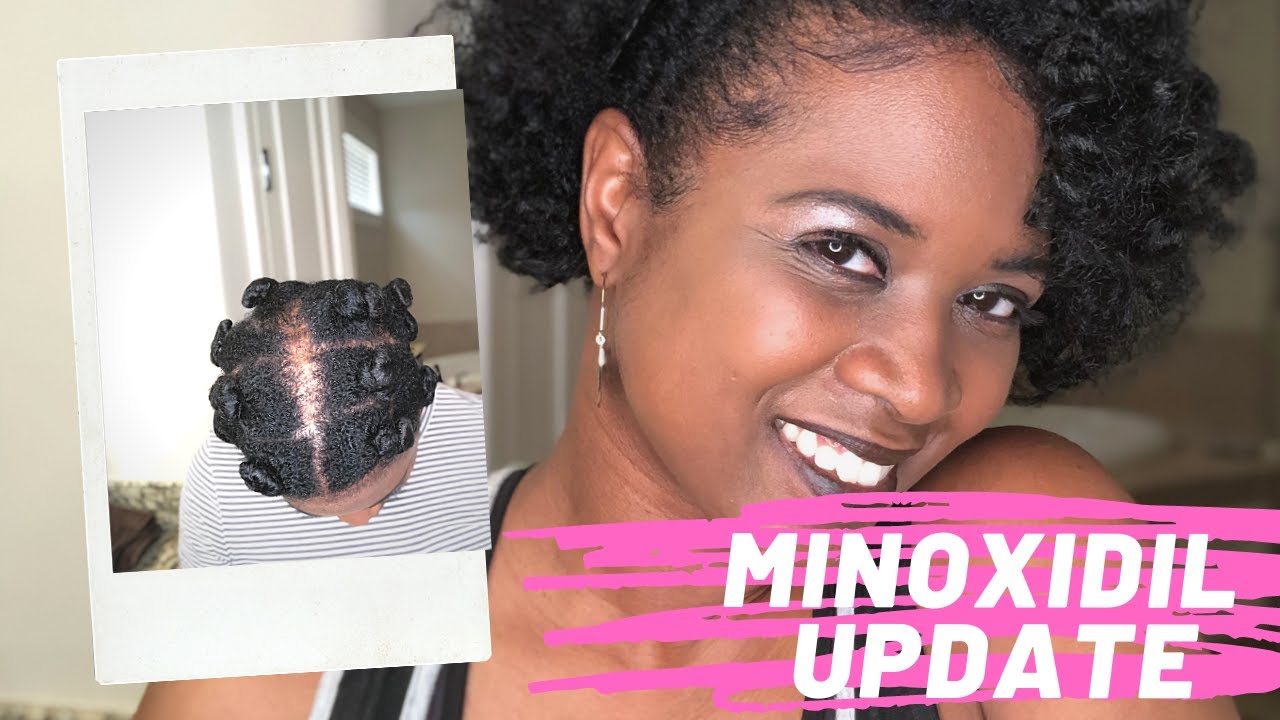 minoxidil-update-womens-hair-loss-treatment-youtube