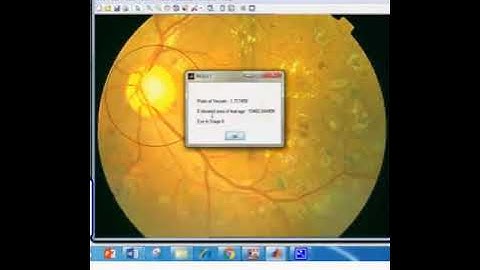 Diabetic retinopathy analysis using machine learning DREAM -MATLAB RESEARCH
