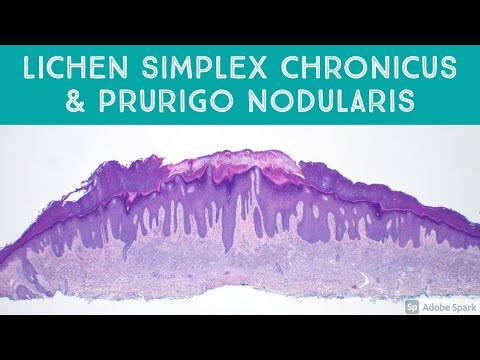 Video: Missä simplex chronicus on?