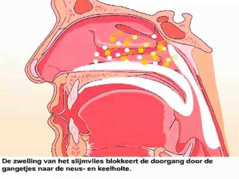 Video: Oorcongestie: Hoe Pijnlijke Sinusdruk Te Verlichten