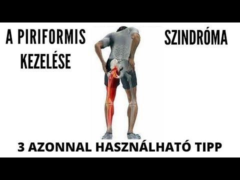 Videó: Piriformis-szindróma: Tünetek, Kezelés és így Tovább