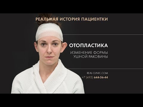 Отопластика\Реальная история пациентки