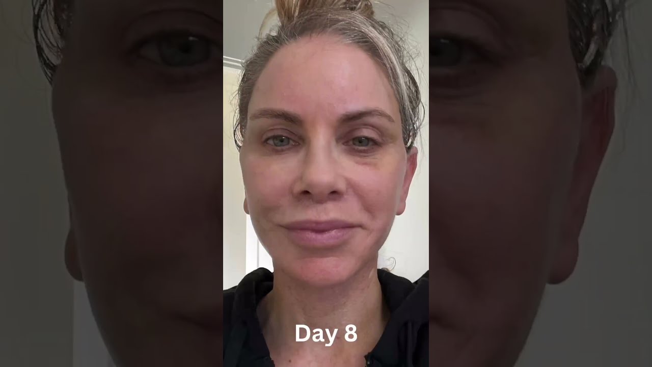 6 WEEK COMPLETE TRANSFORMATION Day By Facelift Progression