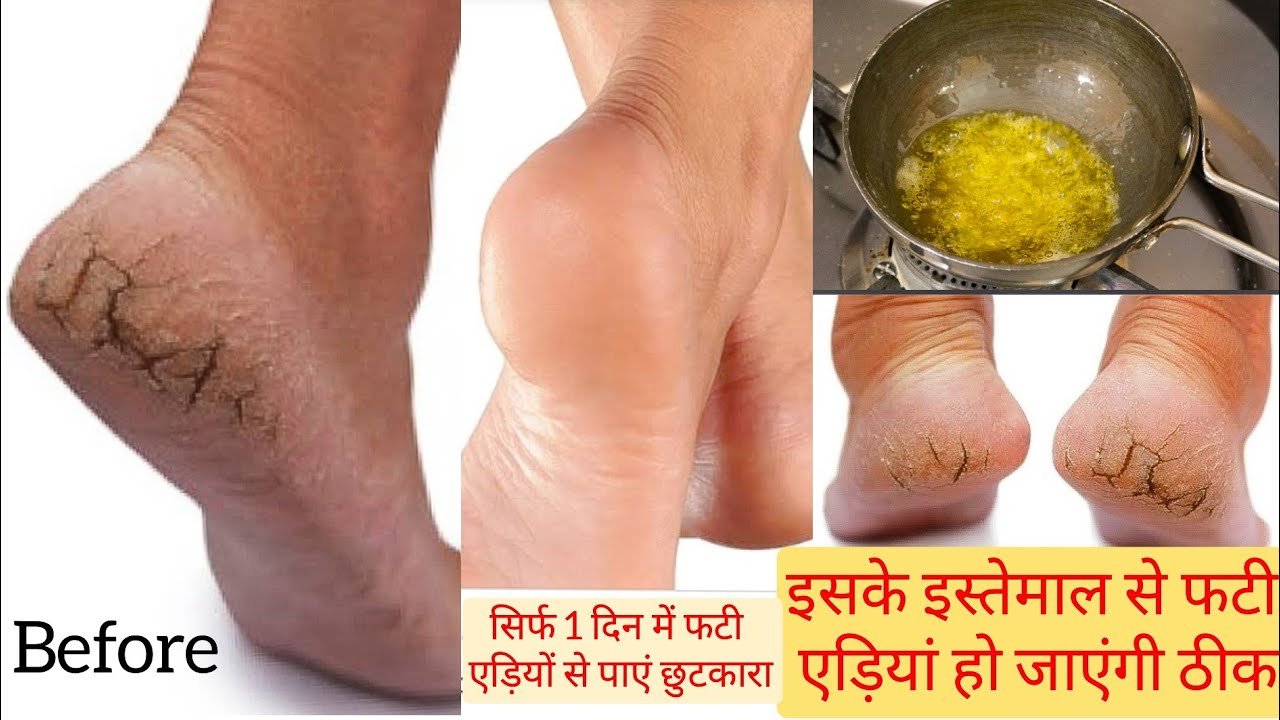 ये एक तरीका अपनाएं और फटी एड़ियों से हमेशा के लिए छुटकारा पाएं Cracked Heels Home Remedy & Treatment
