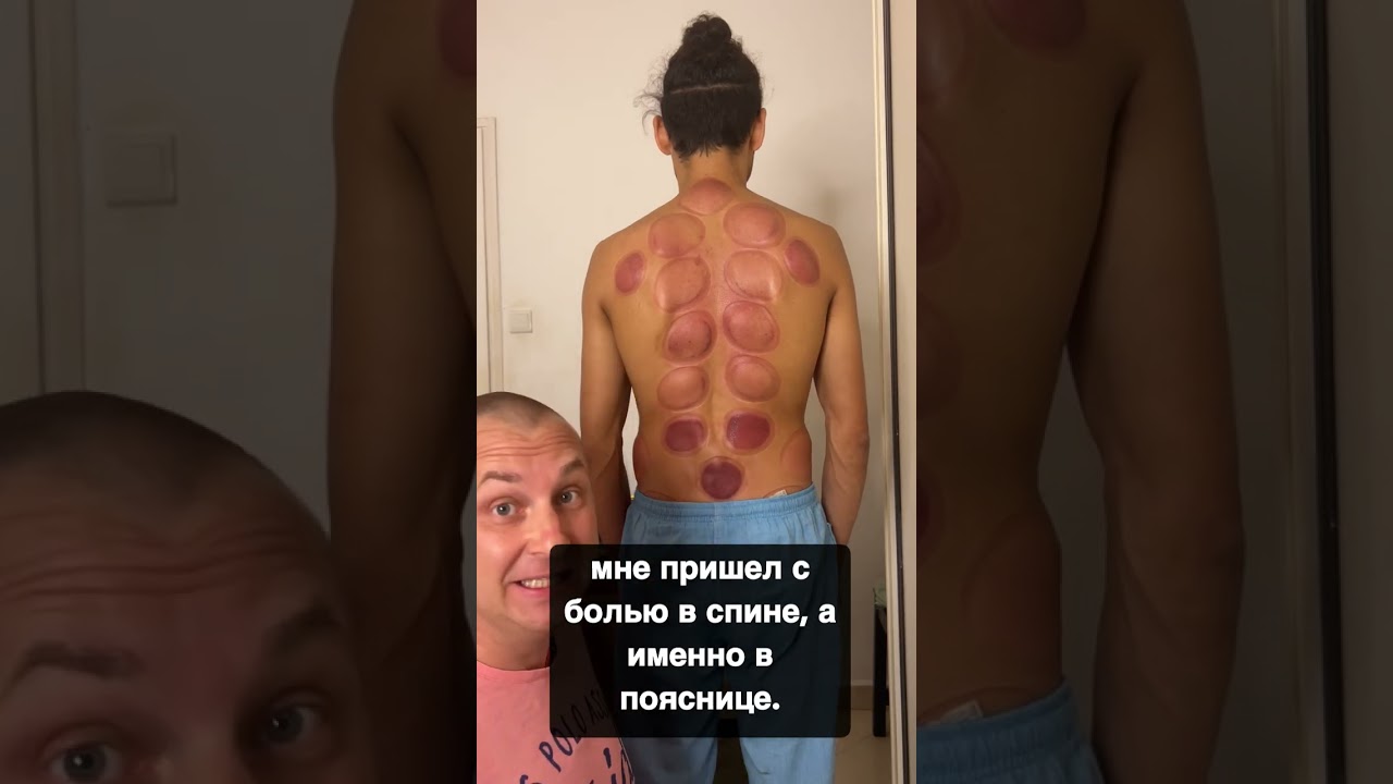 What a result can be after a cupping massage! Diagnostics after vacuum therapy!