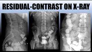 Residual Contrast on X-Ray