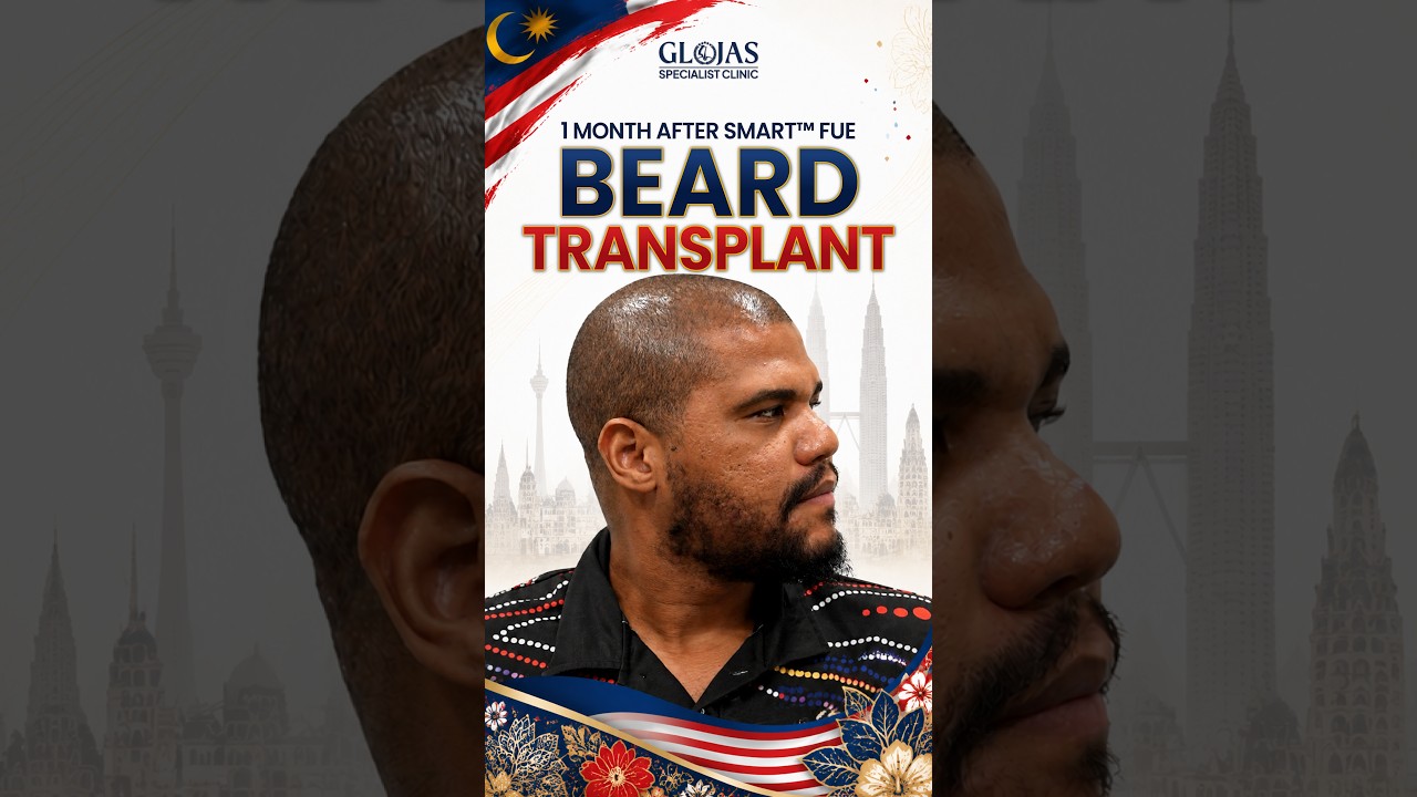 Our Doctors 16 Hair Transplant Malaysia l 1 Month In: Beard Growth Unlocked! 🧔♂️ #hairtransplantmalaysia