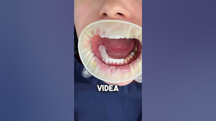 Da li vama treba hollywood smile?