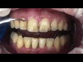 ASMR Dentist 🦷 Teeth Design and Teeth Cleaning l Dentist Cleans Your Teeth!!