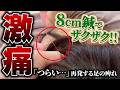 「悪化している…」ビリビリとした足の痺れ|"最悪の状態"を鍼治療で救済できるのか?