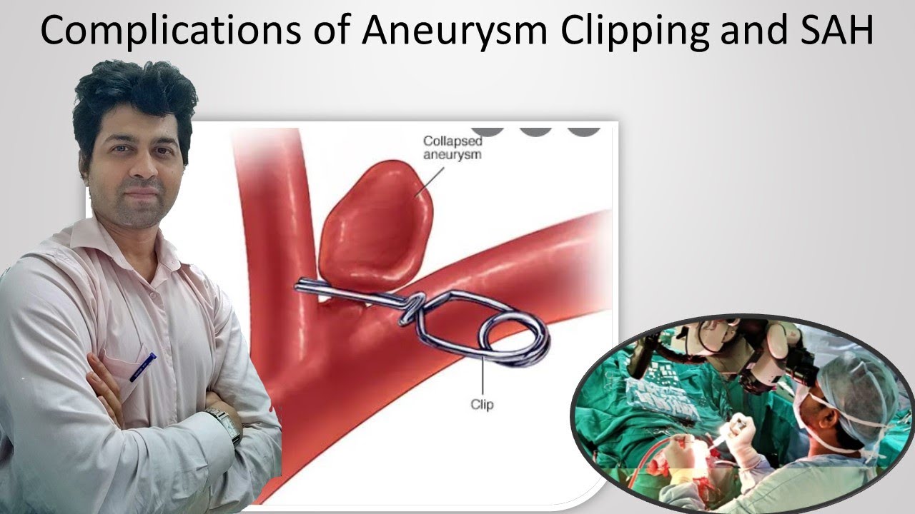 Complications of Brain Aneurysm clipping and SAH. Explained by Dr