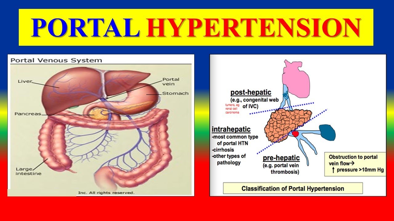 case study on portal hypertension