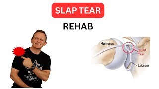 SLAP LESION REPAIR POST OP REHAB. WEEKS 0-4 POST-OP