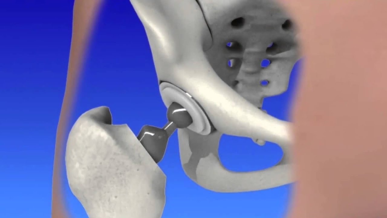 Как делают операцию на тазобедренном. Алмаг 01 эндопротез тазобедренного сустава. Коксартроз тазобедренного сустава операция. Коксартроз эндопротезирование тазобедренного сустава. Тазобедренный эндопротез Stryker.