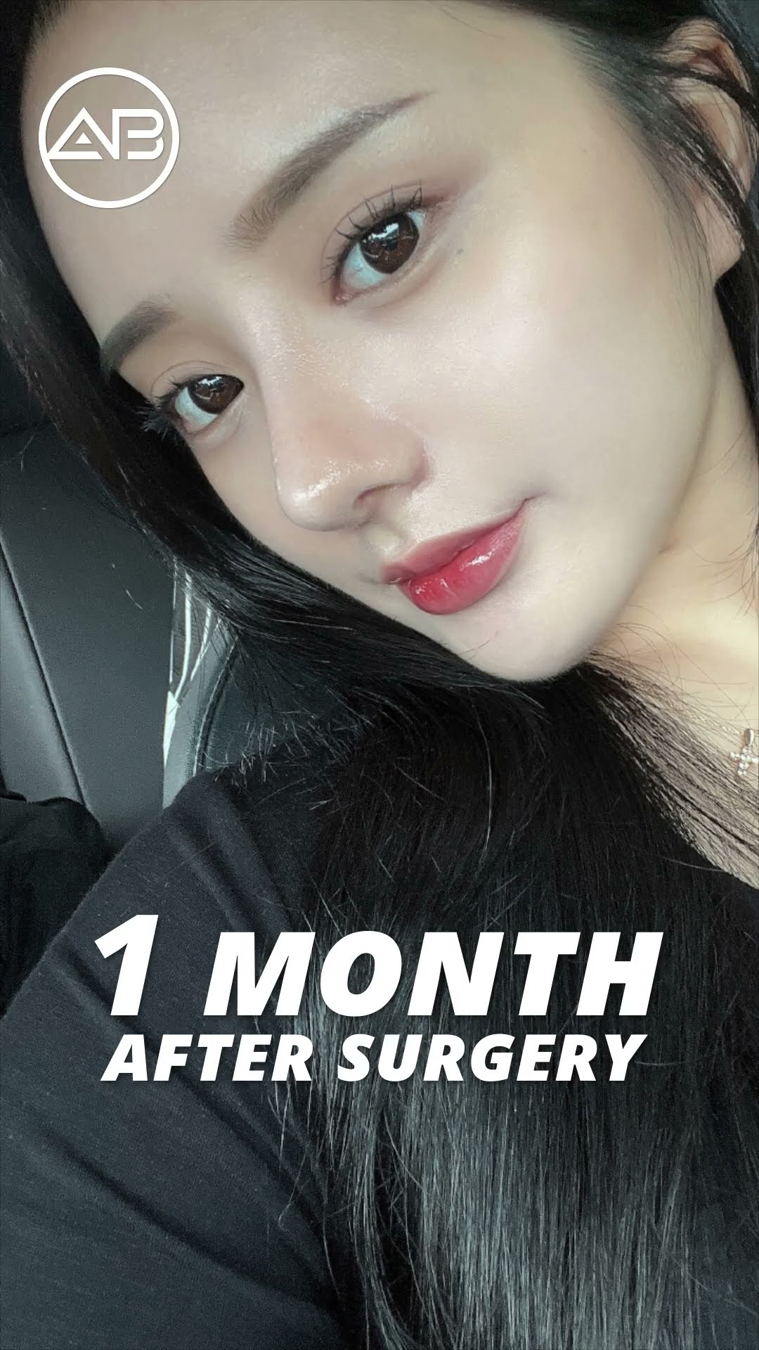 [Plastic surgery in Korea] Revision Rhinoplasty + Wide Nose + Alar Base Reduction #abplasticsurgery