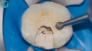 Endodontic treatment - حشو العصب