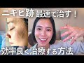 治療費100万以上かけて分かった!効率よくクレーター跡を治療する方法