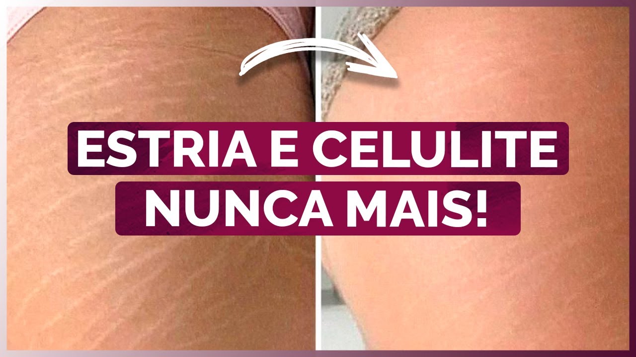 Como ACABAR com ESTRIA e CELULITE NATURALMENTE (Melhor tratamento ...