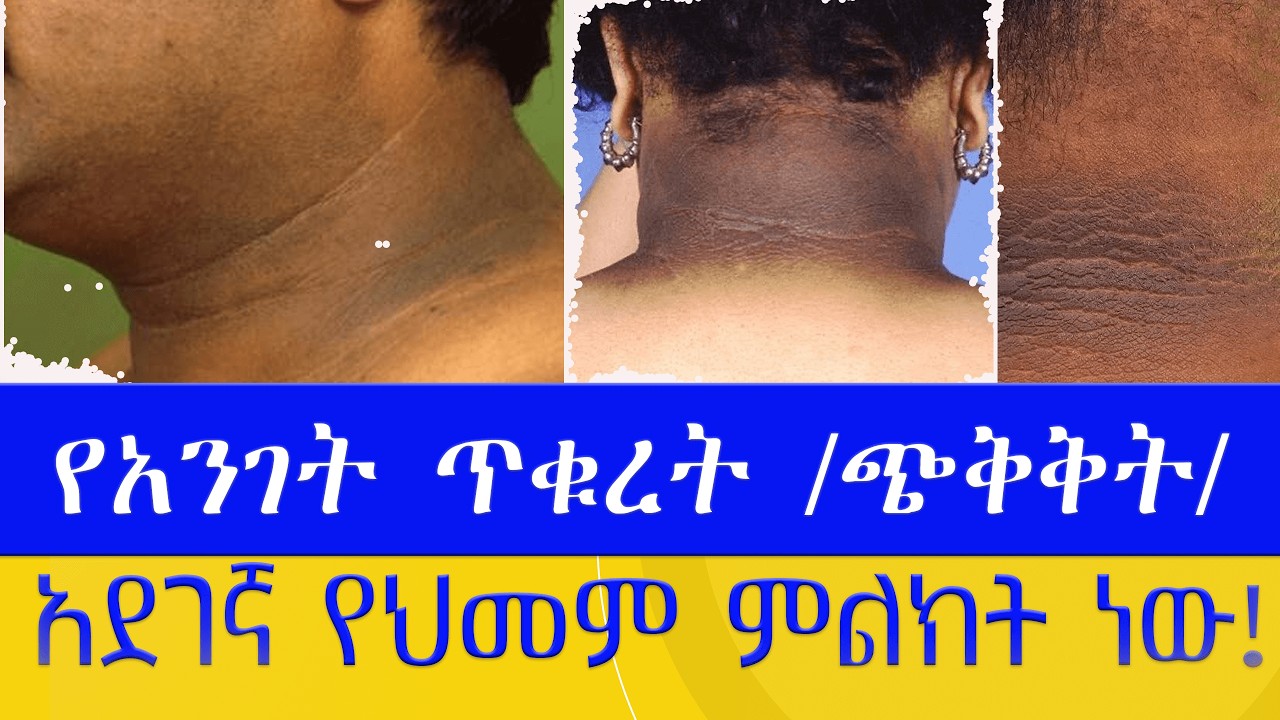 የአንገት ጥቁረት/ጭቅቅት/አደገኛ የህመም ምልክት ነው/ 3 መፍትሄዎች/ Acanthosis nigricans is a sign of Insulin Resistance/