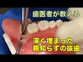 【横浜戸塚　内藤歯科】埋伏親知らずの抜歯の説明