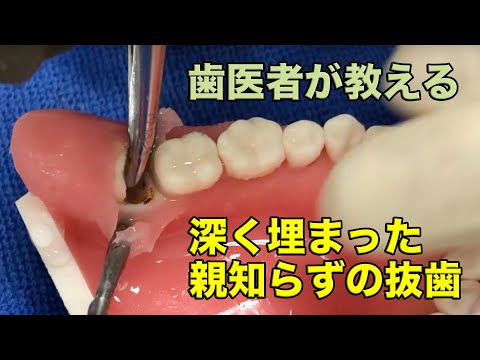 [Naito dentistry] Explanation of tooth extraction of impacted wisdom tooth