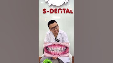 Niềng Răng Một Hàm Có Hiệu Quả Không, Vì Sao? | Nha khoa Sdental #shorts