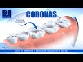 ▷ Colocación de una CORONA DENTAL Málaga | Clínicas dentales en Málaga y Marbella | Boca&Boca