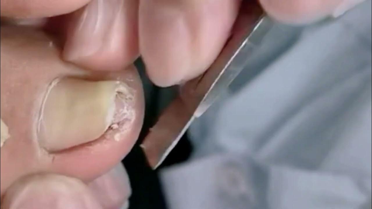 Curled and ingrown toenail cutting treatment He Pedicure YouTube
