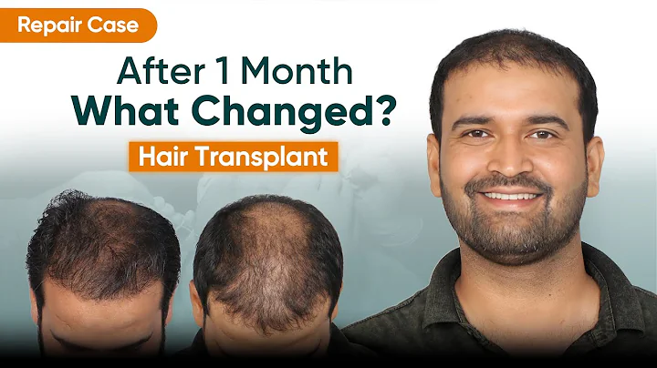 Hair Transplant Repair Case (HX-MGDW) | 1-Month Post Surgery Recovery Explained