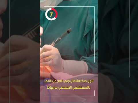 لأول مرة استئصال ورم بالمخ من الأنف بالمستشفى التخصصى بدمياط