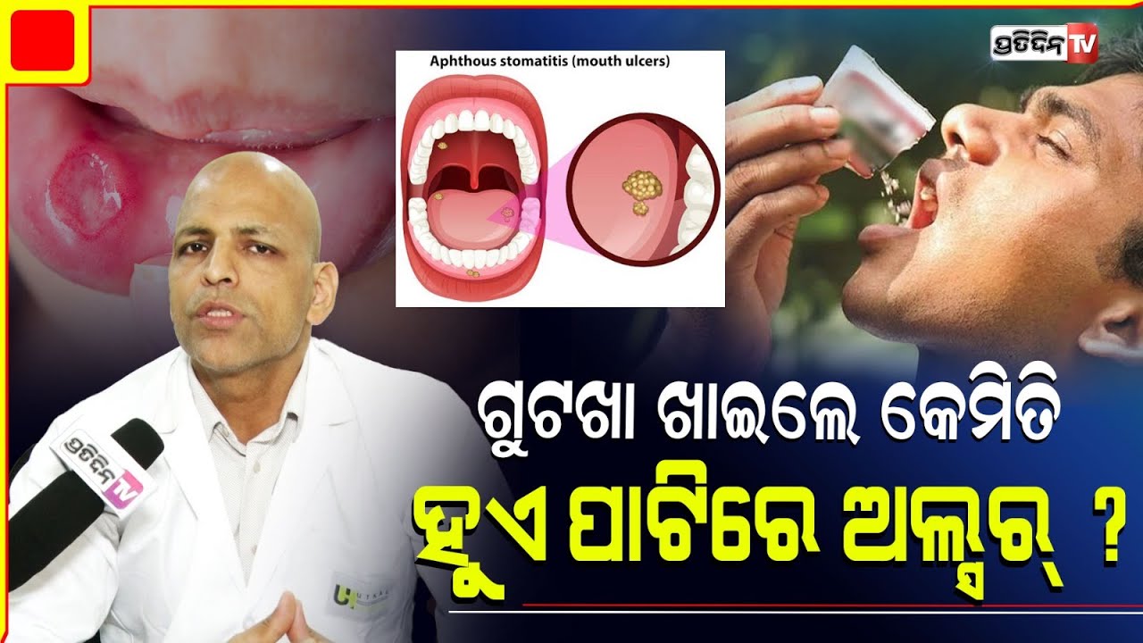 ଗୁଟଖା ଖାଇଲେ କେମିତି ପାଟିରେ ହୁଏ ଅଲ୍ସର୍? Mouth cancer and Treatment.