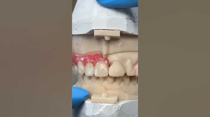 Metal Try-In @EnvisiontecMain #envisiontec #dental #teeth #smile #lsk121shorts #shortvideo #shorts