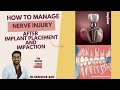 How to manage nerve injury after placing implants