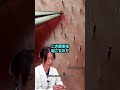埋没毛の処理をしている動画を見て、皮膚科医のたかし先生が解説!