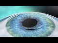 What is LASIK?