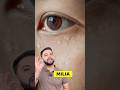 Milia, Tiny Bumps & Clogged Pores Permanent Treatment 3 Step Skincare Routine