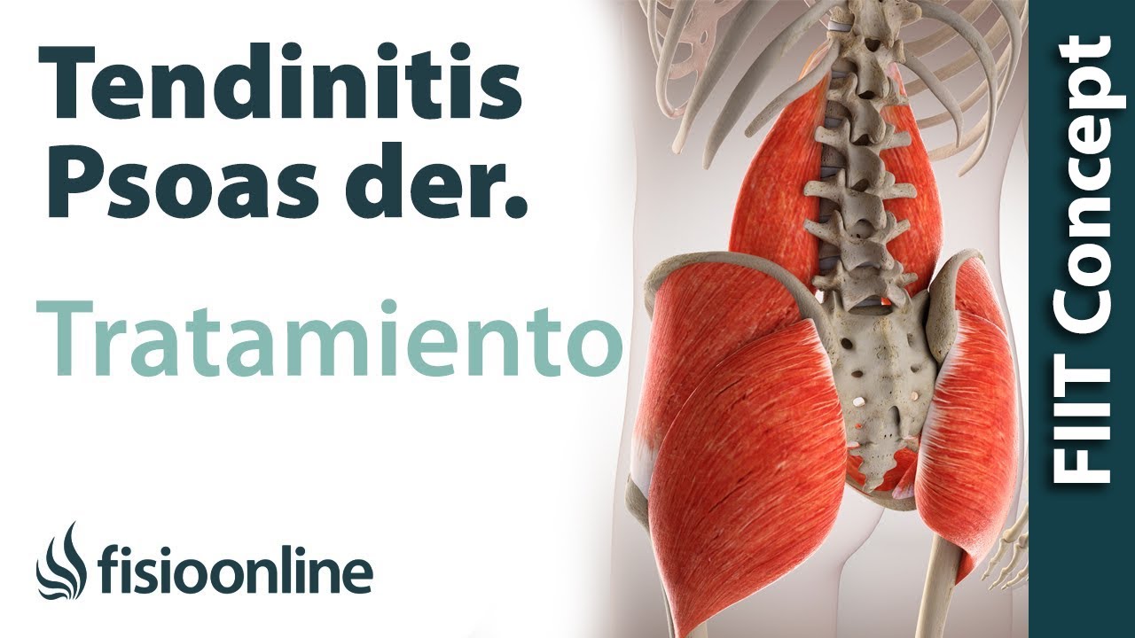 Tendinitis del psoas iliaco pdf