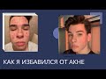 Как я избавился от акне| МОЯ ИСТОРИЯ АКНЕ