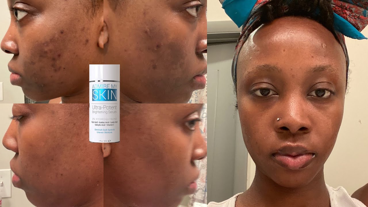 Diminish dark spots, hyperpigmentation and uneven skin tone fast with