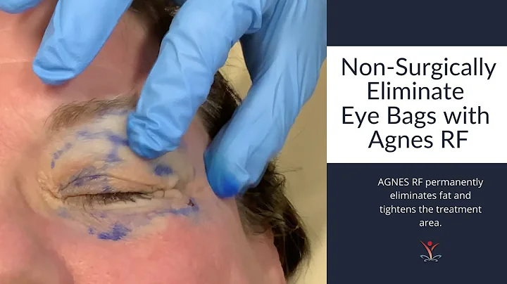 Non-Surgically Treat Eye Bags with Agnes RF